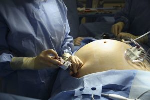 Bariatric Surgery's